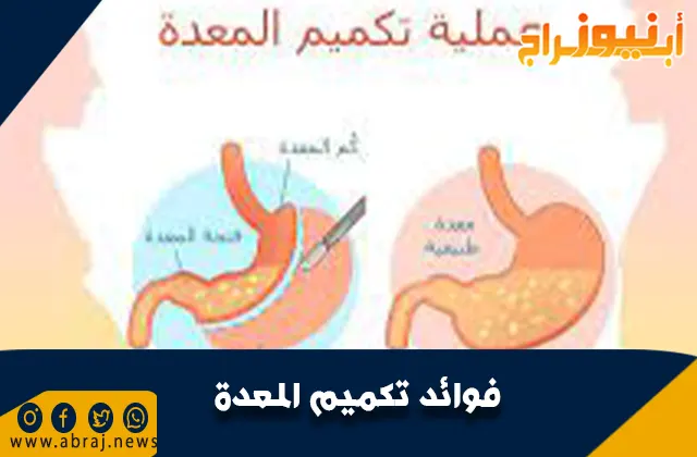 فوائد تكميم المعدة .. نصائح طبية