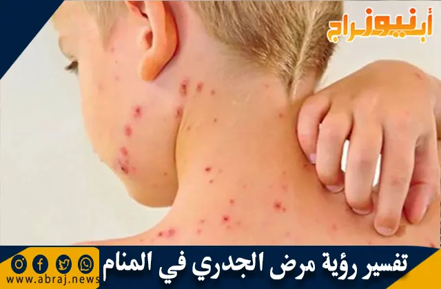 تفسير رؤية مرض الجدري في المنام بالتفصيل