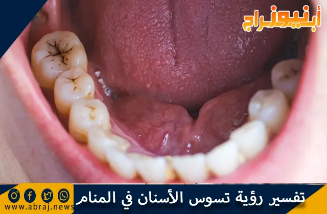 تفسير رؤية تسوس الأسنان في المنام بالتفصيل