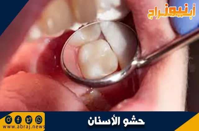 حشو الأسنان