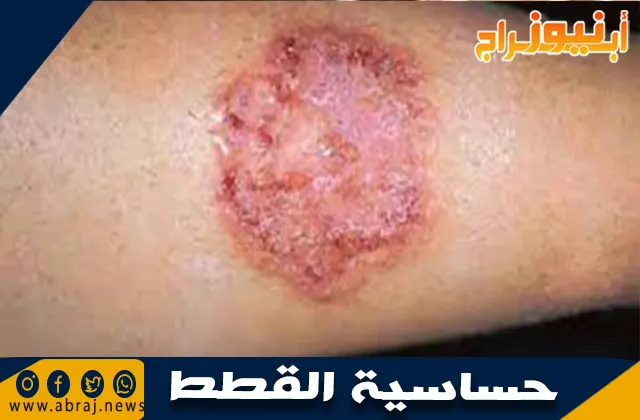 هل حساسية القطط خطيرة؟