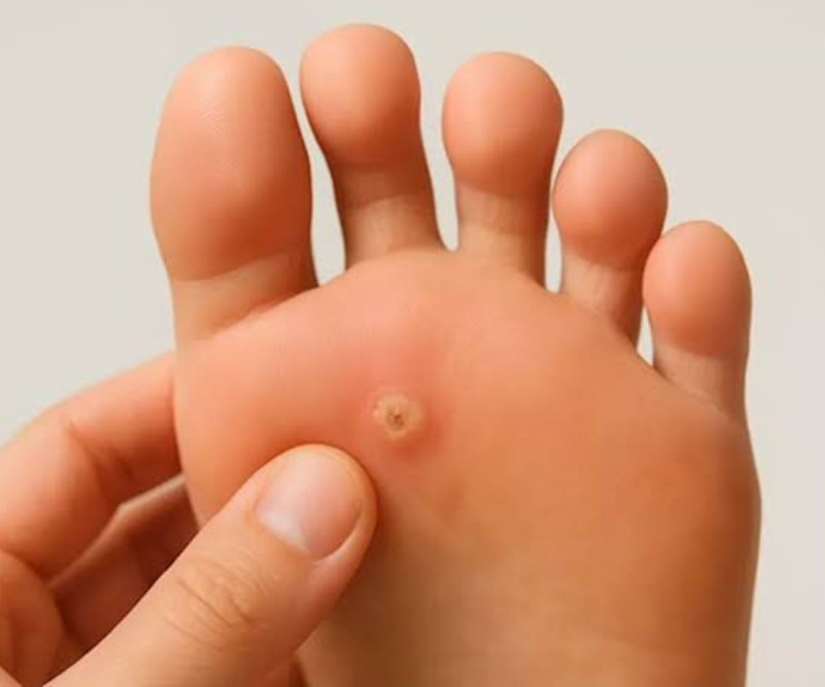 علاج مسمار القدم وطرق الوقاية منه