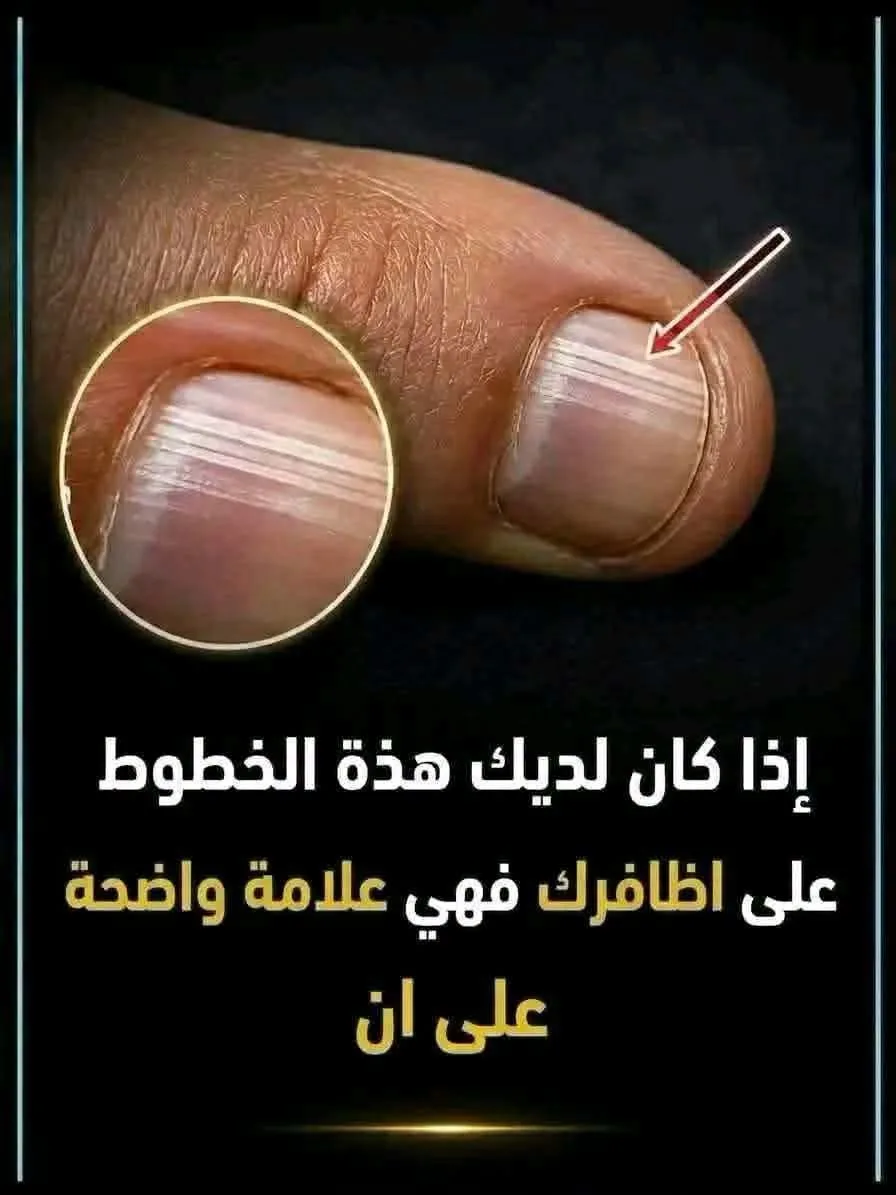 ماذا يعني الخطوط على الأظافر: أنواع الخطوط على اظافرك أفقية، عمودية، ع