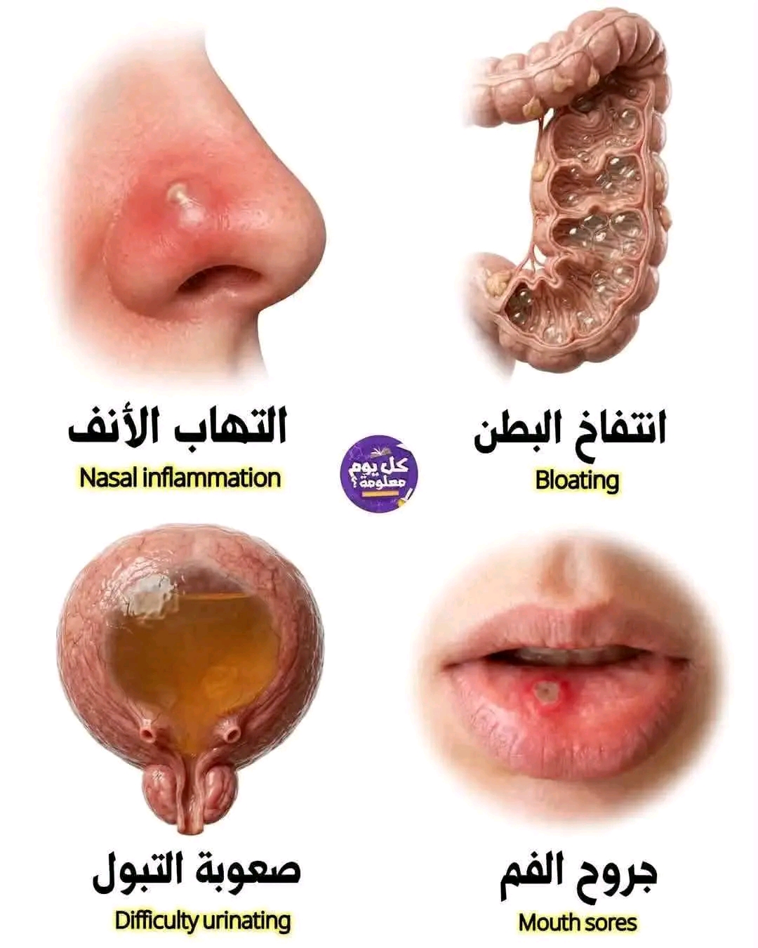 انتفاخ البطن