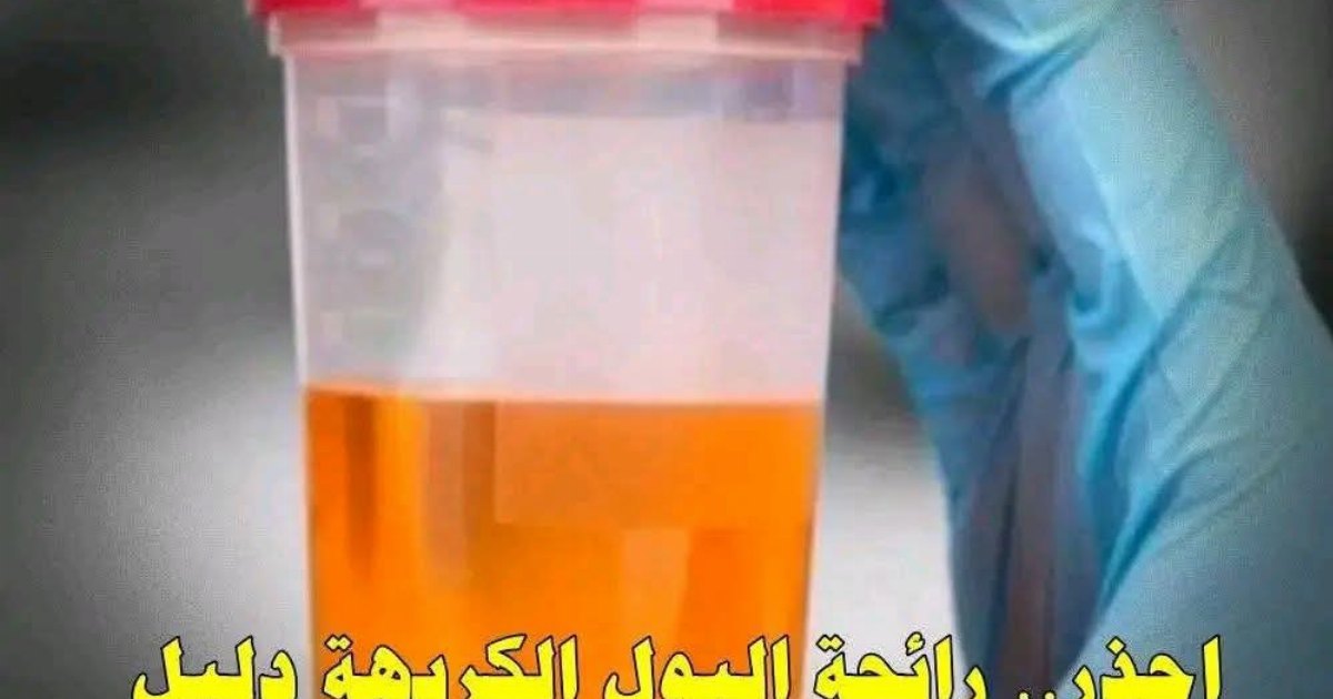 رائحة الب.ول الكريهة قد تكون دليلا على إصابتك بـ 4 أمراض.. عرض المزيد