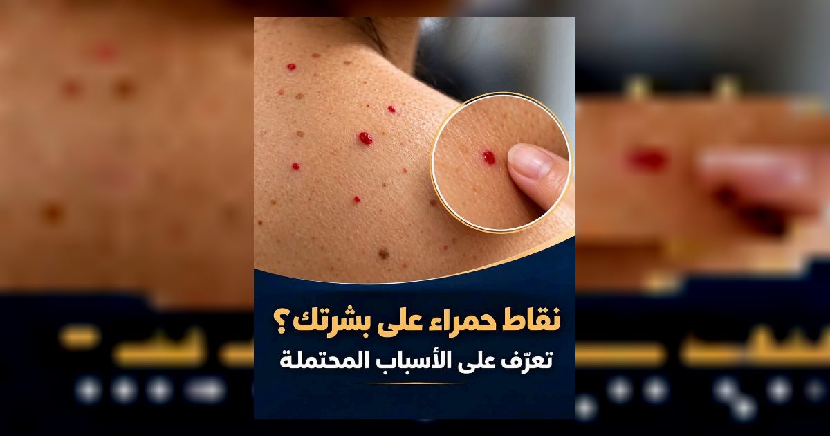 أسبـ.ـاب ظهور نقاط حمـ.ـراء على بشرتك.. الطبيب يكشف معناها المحتمل