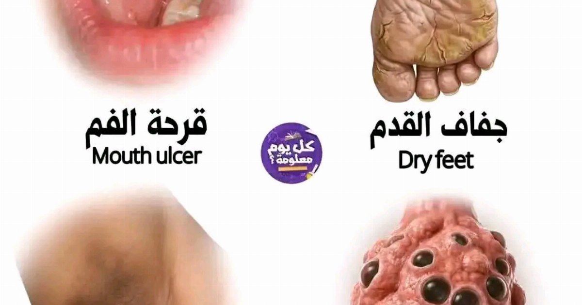 جفاف القدم