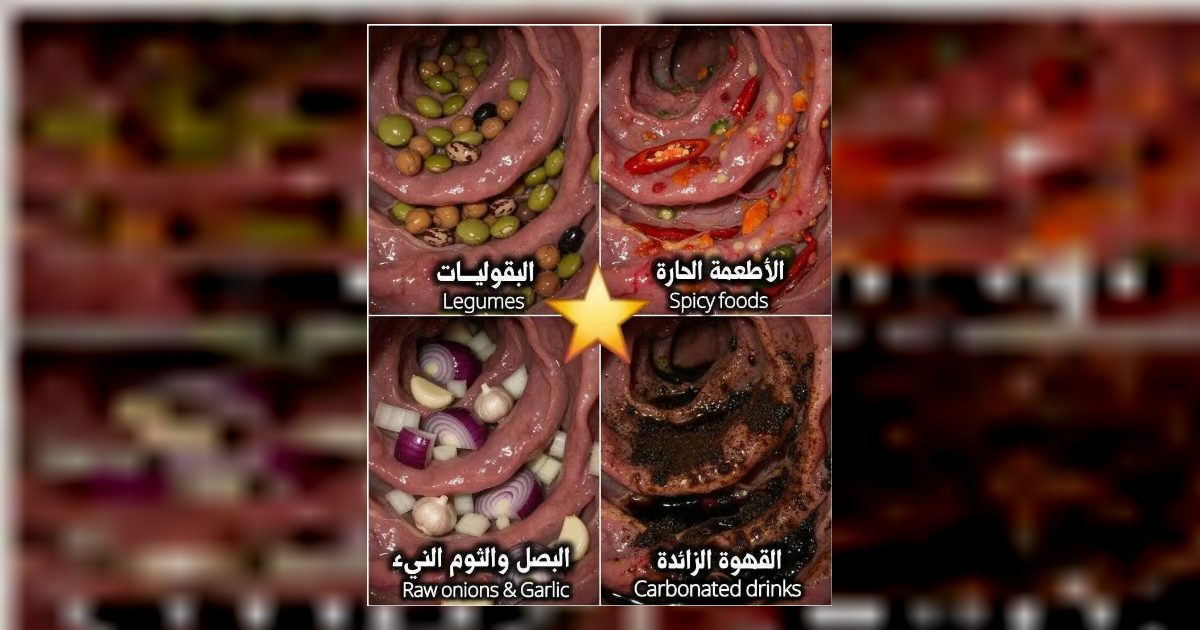 الأطعمة الحارة : قد تهيج القولون وتزيد التقلصات.......المزيد