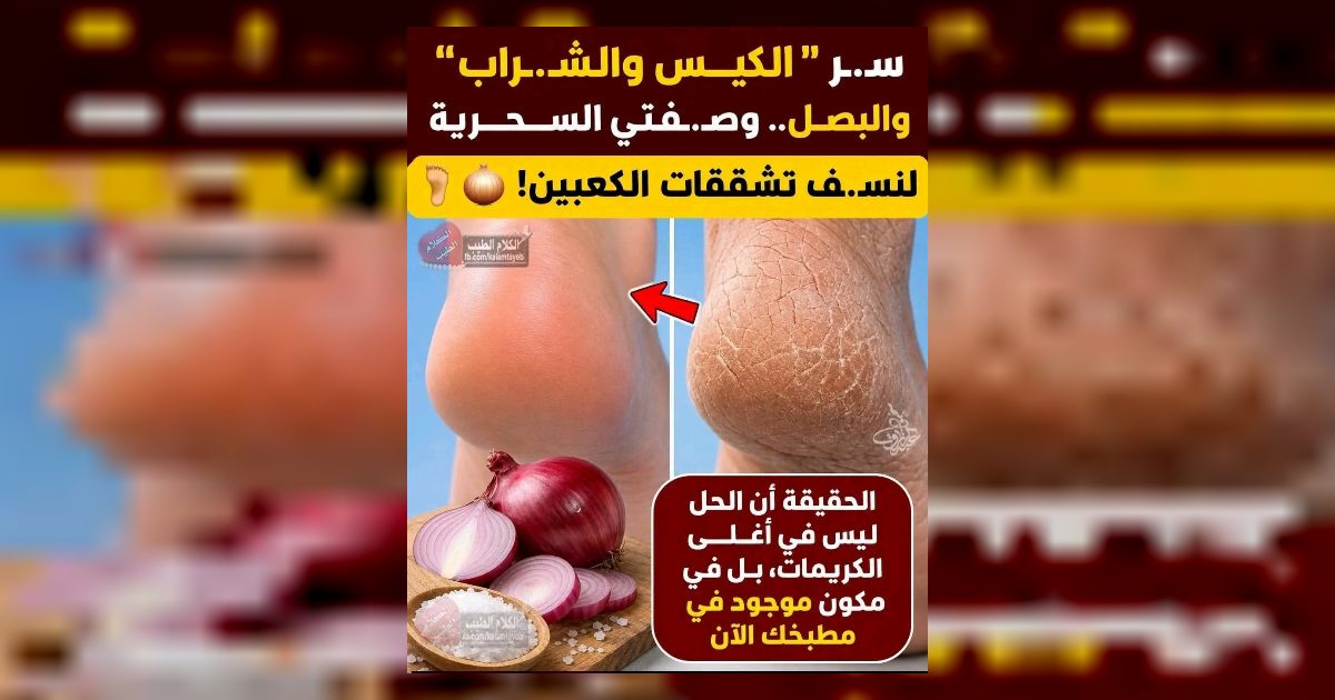 تشقق الكعبين