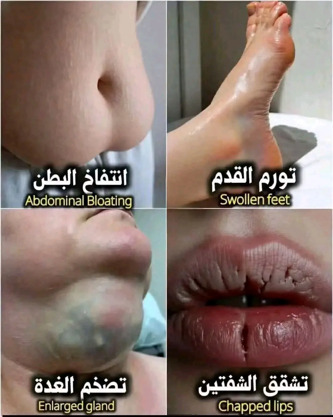 تورم القدم