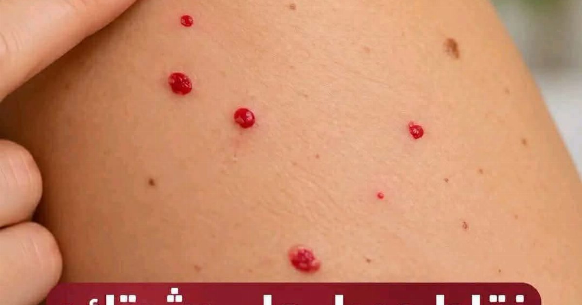 معنى ظهور نقاط حمـ.ـراء على بشرتك.. الطبيب يشرح اسبـ.ـابها وكيفية الوقـ.ـاية للحصول على التفـ.ـاصيل اكـ.ـتب “OK” او تـ.ـم وشـ.ـاهد أول تعـ.ـليق