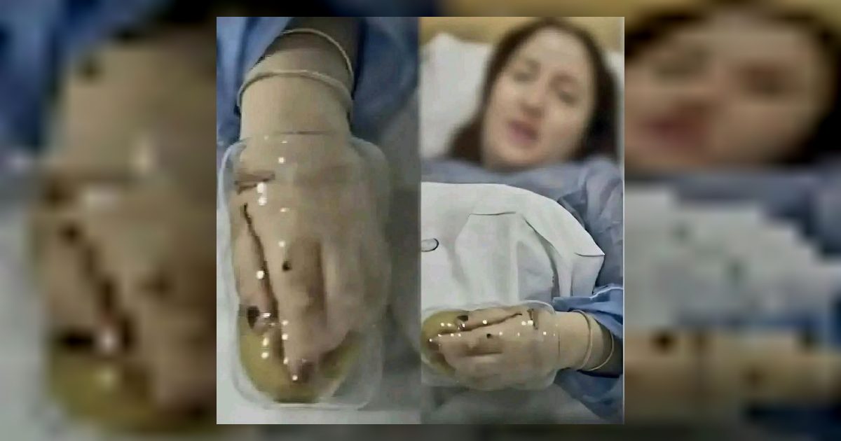 عمـ ـلية جـ ـراحية لسيدة علقت يدها داخل كوباية زجاجية  أدى إلى حـ ـاد..عرض المزيد