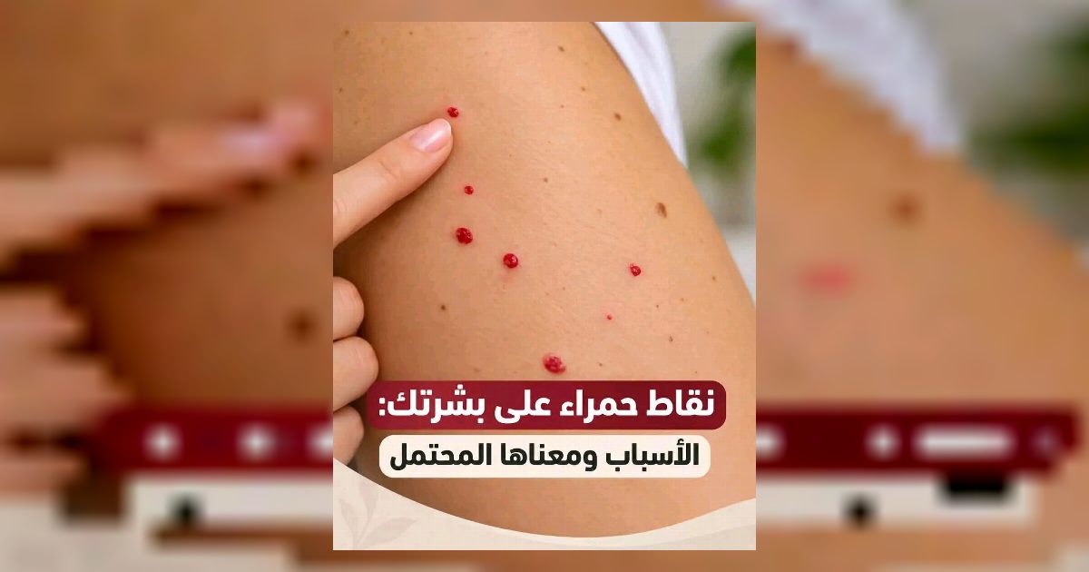 معنى ظهور نقاط حمـ.ـراء على بشرتك.. الطبيب يشرح اسبـ.ـابها وكيفية الوقـ.ـاية