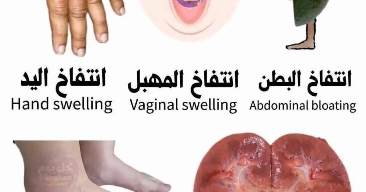 انتفا.خ  البطن