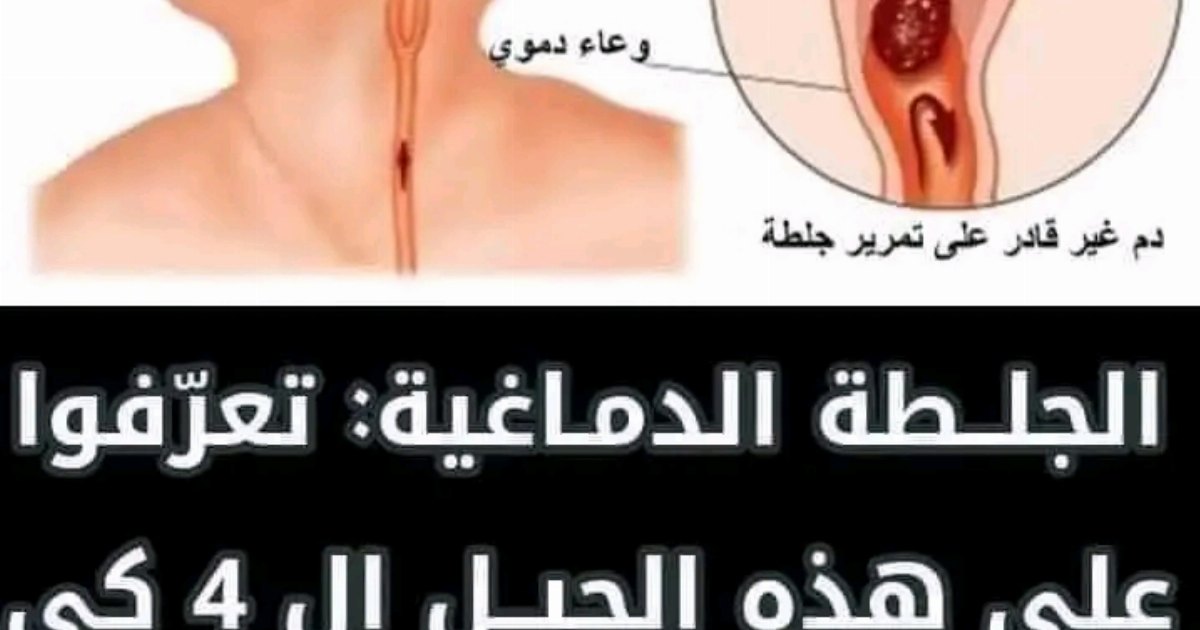 علامات مبكرة لحدوث الجـ،،لـــ،ـطـــ،ـه الدماغية من المهم أن تعرفها إذا ظهرت عليك قد تكون بداية الجـ،،لـــ،ـطـــ،ـه دون أن تعلم (تفاصيل أول تعليق)