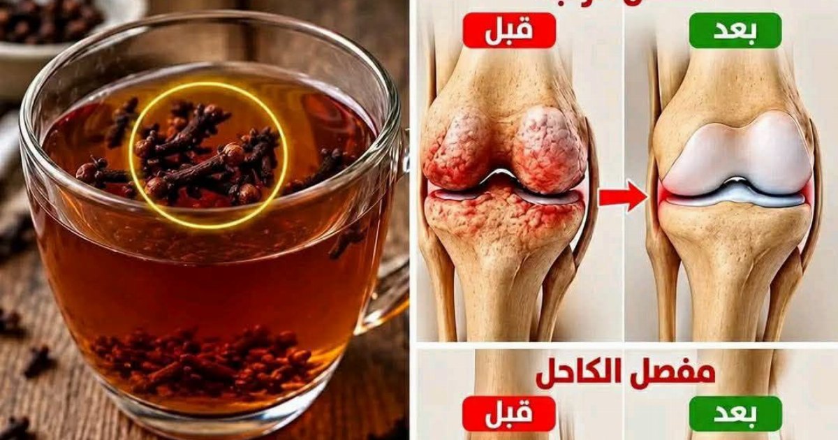 فـ.ـوائد القرنفل واستخدامات مشروب القرنفل لتقـ.ـوية العظام وتسكـ.ـين الم المفـ.ـاصل