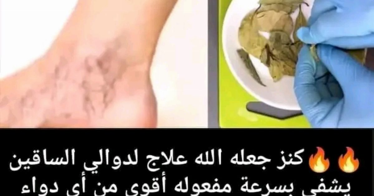 كنز جعله الله عـ،،لاَج لدوالي الساقين و أَلـ،،م الساقين يشفي بسرعة مفعوله أقوى من أي دواء سبحان الله وصفة تغنيك عن أي عمل التفاصيل اول تعليق