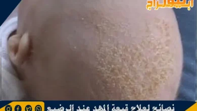 نصائح لعلاج قبعة المهد عند الرضيع