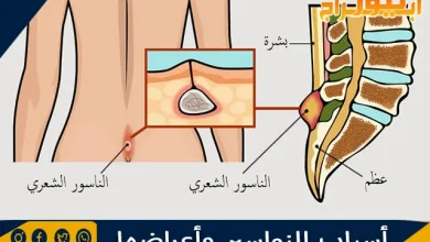 أسباب النواسير وأعراضها ونصائح علاج الناسور