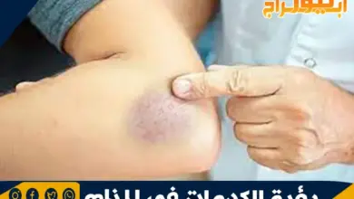 رؤية الكدمات في المنام